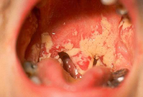 Nguyên nhân gây bệnh lậu ở miệng