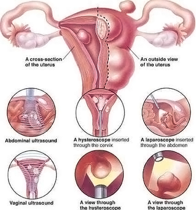Xơ hóa tử cung là gì, Nguyên nhân và cách chữa xơ hóa tử cung?